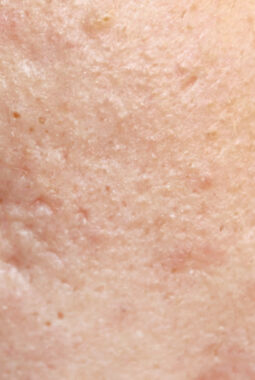 MOLD Manila Unveils PRP Therapy: A Revolutionary Approach to Revitalize Your Skin’s Natural Glow